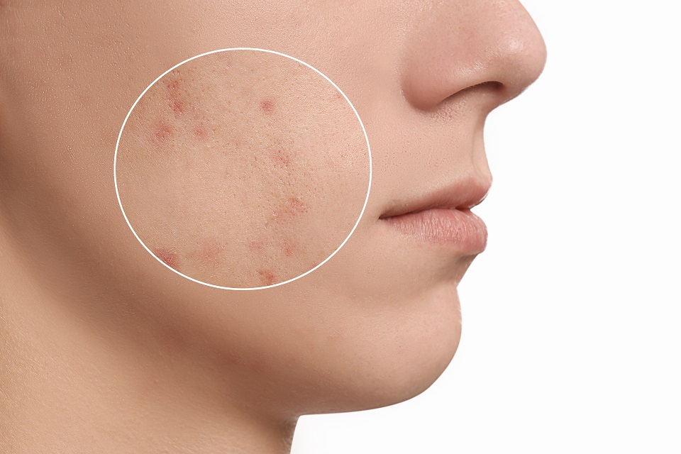 8 Treatment Kecantikan untuk Menghilangkan Bekas Jerawat - AFK Beauty